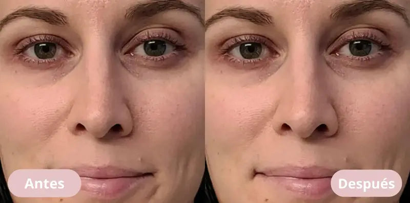 Antes y después: ojeras y contorno de ojos más firme
