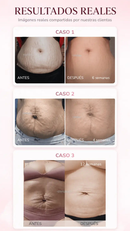Casos reales: estrias menos visibles en 4-12 semanas