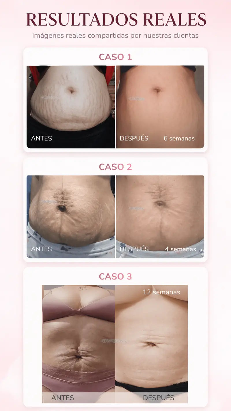 Casos reales antes y despues: estrias menos visibles en 4 a 12 semanas