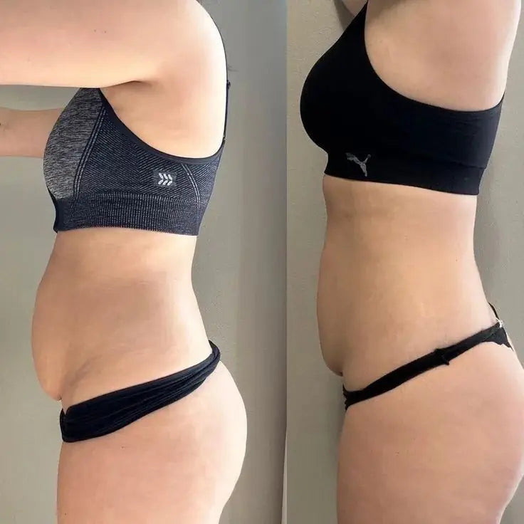 Antes y después: retención de líquidos en el abdomen