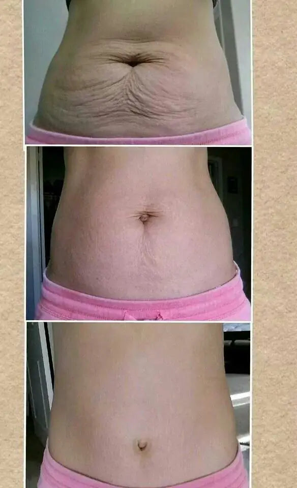 Evolución del abdomen semana a semana con Linfovit